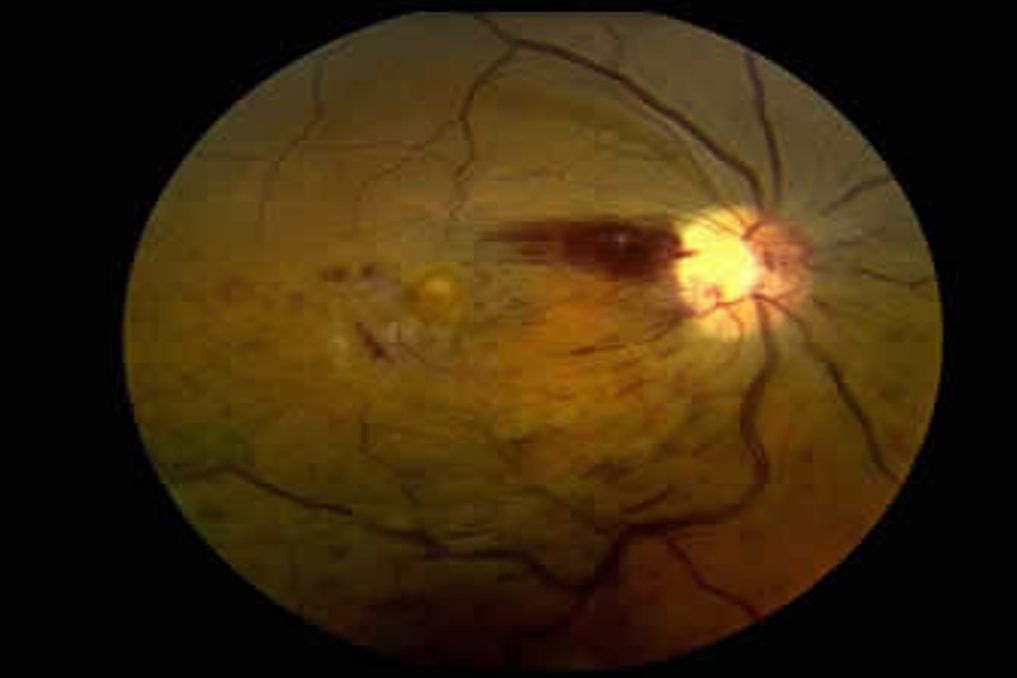 Retina Damar Tıkanıklıkları